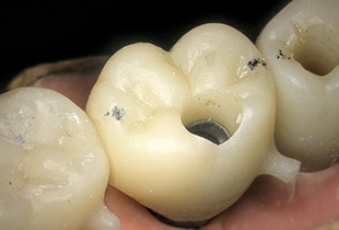 Dental Implant Observation